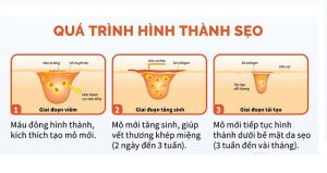 Điều trị sẹo công nghệ cao – Giải pháp xoá sẹo nhanh không đau