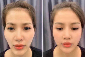 Độn Thái Dương – Trẻ Hóa Gương Mặt Chỉ Sau 30 Phút