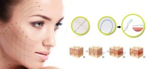 Căng Chỉ Collagen – Giải pháp trẻ hoá da của phái đẹp