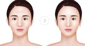 Các bệnh nào không được nâng mũi ?